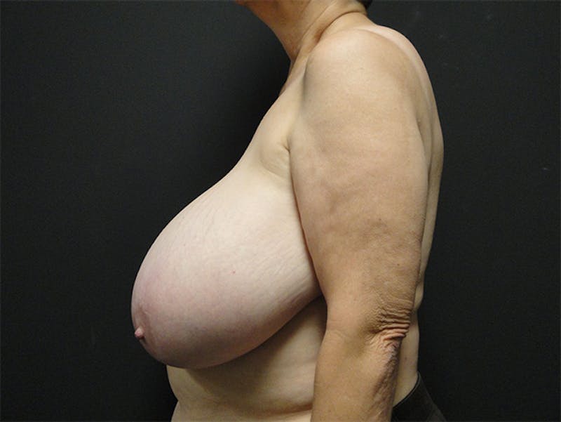 Breast Flap Reconstruction Before & After Gallery - Patient 167358292 - Image 5