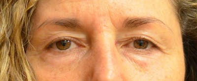 Eyelid Surgery Before & After Gallery - Patient 167358296 - Image 1