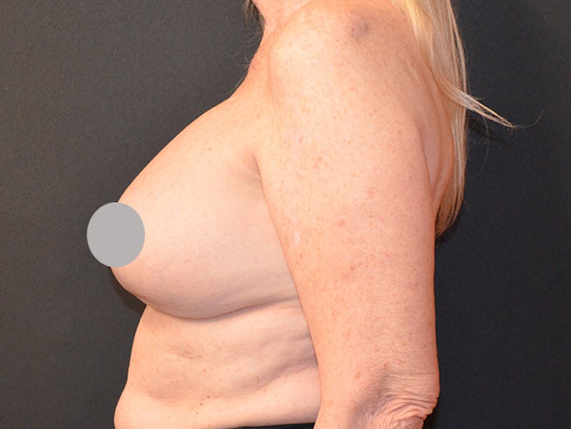 En Bloc Capsulectomy Before & After Gallery - Patient 167358297 - Image 3