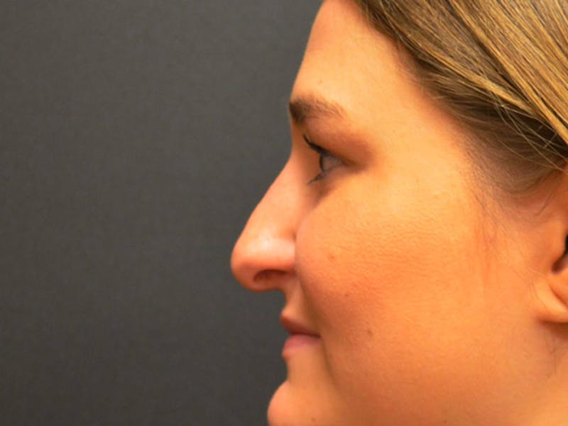 Rhinoplasty Before & After Gallery - Patient 167358289 - Image 4