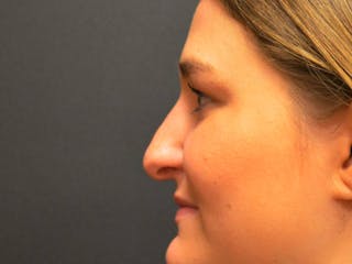 Rhinoplasty Before & After Gallery - Patient 167358289 - Image 4