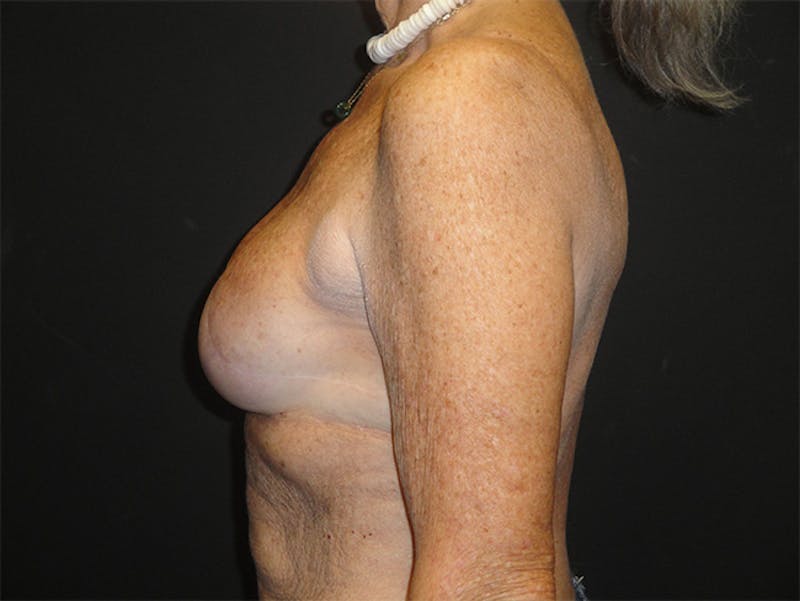 Breast Implant Reconstruction Before & After Gallery - Patient 167358291 - Image 8