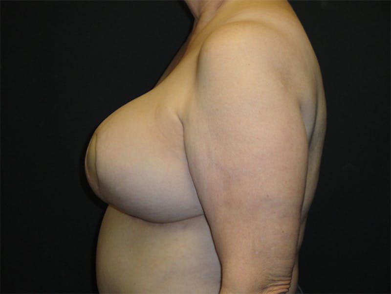 Breast Flap Reconstruction Before & After Gallery - Patient 167358292 - Image 6
