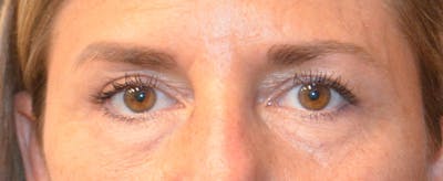 Eyelid Surgery Before & After Gallery - Patient 167358296 - Image 2