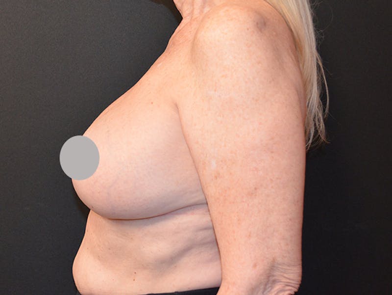 En Bloc Capsulectomy Before & After Gallery - Patient 167358297 - Image 4