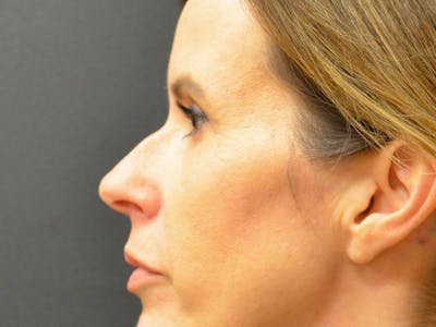 Rhinoplasty Before & After Gallery - Patient 167358300 - Image 1