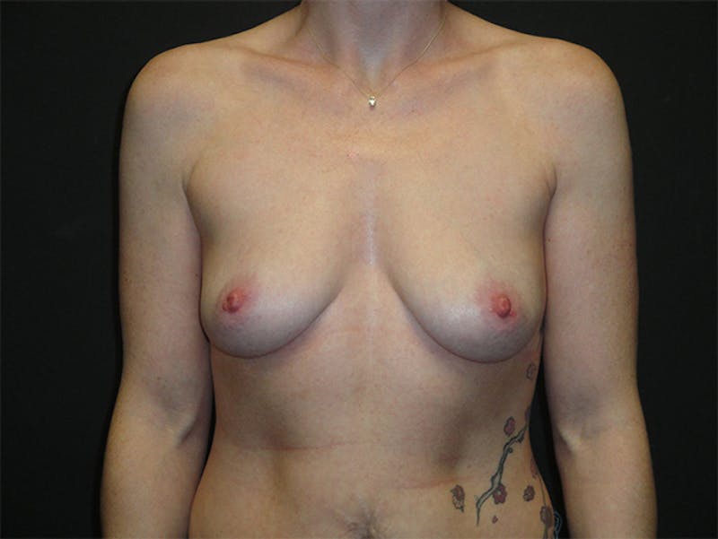 Breast Implant Reconstruction Before & After Gallery - Patient 167358304 - Image 1