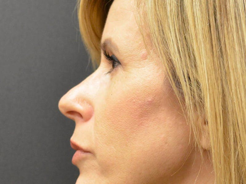 Rhinoplasty Before & After Gallery - Patient 167358300 - Image 2