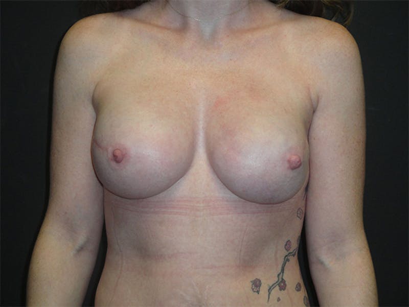 Breast Implant Reconstruction Before & After Gallery - Patient 167358304 - Image 2