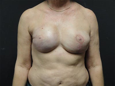Breast Flap Reconstruction Before & After Gallery - Patient 167358307 - Image 2