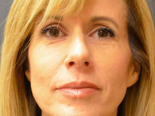 Rhinoplasty Before & After Gallery - Patient 167358300 - Image 4