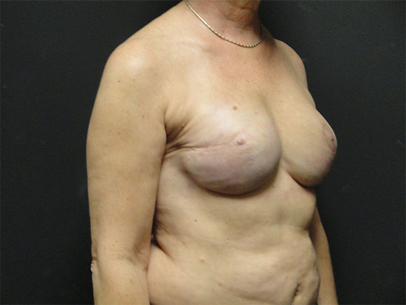 Breast Flap Reconstruction Before & After Gallery - Patient 167358307 - Image 4