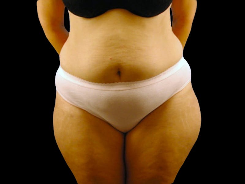 Tummy Tuck Before & After Gallery - Patient 167358308 - Image 1
