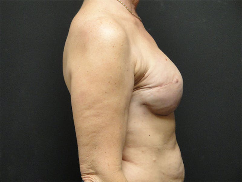 Breast Flap Reconstruction Before & After Gallery - Patient 167358307 - Image 6