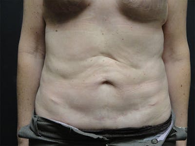 Tummy Tuck Before & After Gallery - Patient 167358332 - Image 1