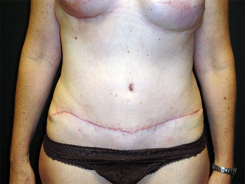 Tummy Tuck Before & After Gallery - Patient 167358332 - Image 2