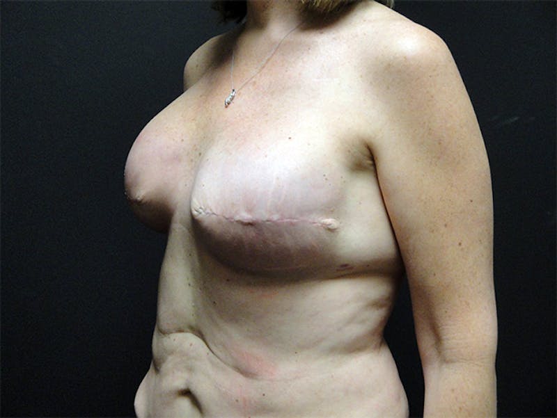Tummy Tuck Before & After Gallery - Patient 167358332 - Image 3