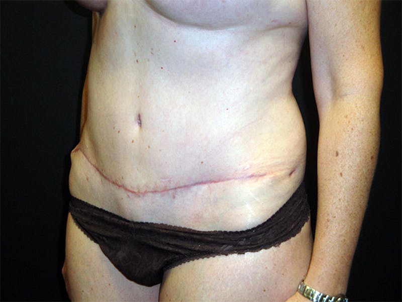 Tummy Tuck Before & After Gallery - Patient 167358332 - Image 4