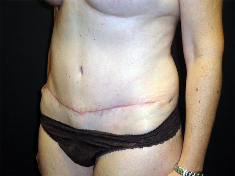 Tummy Tuck Before & After Gallery - Patient 167358332 - Image 4