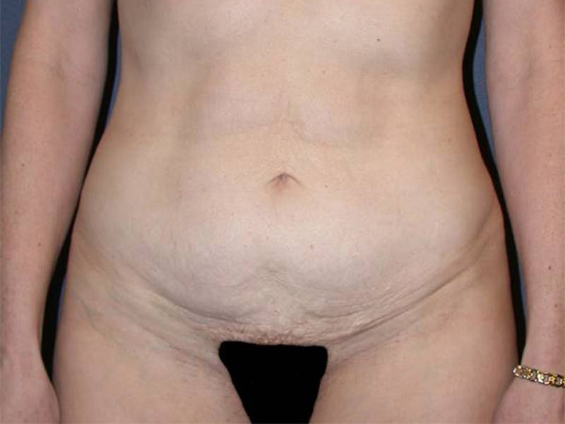 Tummy Tuck Before & After Gallery - Patient 167358357 - Image 1