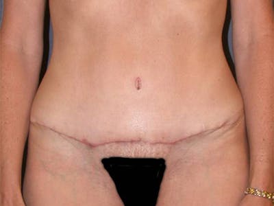 Tummy Tuck Before & After Gallery - Patient 167358357 - Image 2