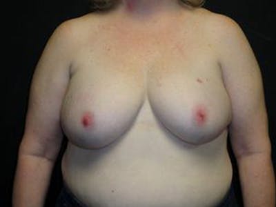 Breast Implant Reconstruction Before & After Gallery - Patient 167358358 - Image 1