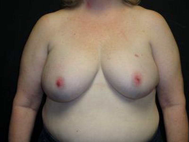 Breast Implant Reconstruction Before & After Gallery - Patient 167358358 - Image 1