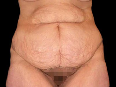 Liposuction Before & After Gallery - Patient 167358361 - Image 1