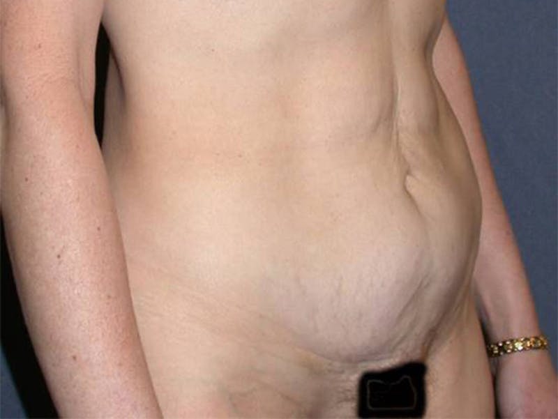 Tummy Tuck Before & After Gallery - Patient 167358357 - Image 3