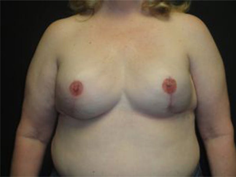 Breast Implant Reconstruction Before & After Gallery - Patient 167358358 - Image 2