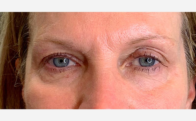 Microblading Before & After Gallery - Patient 167358359 - Image 1