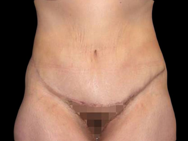 Liposuction Before & After Gallery - Patient 167358361 - Image 2