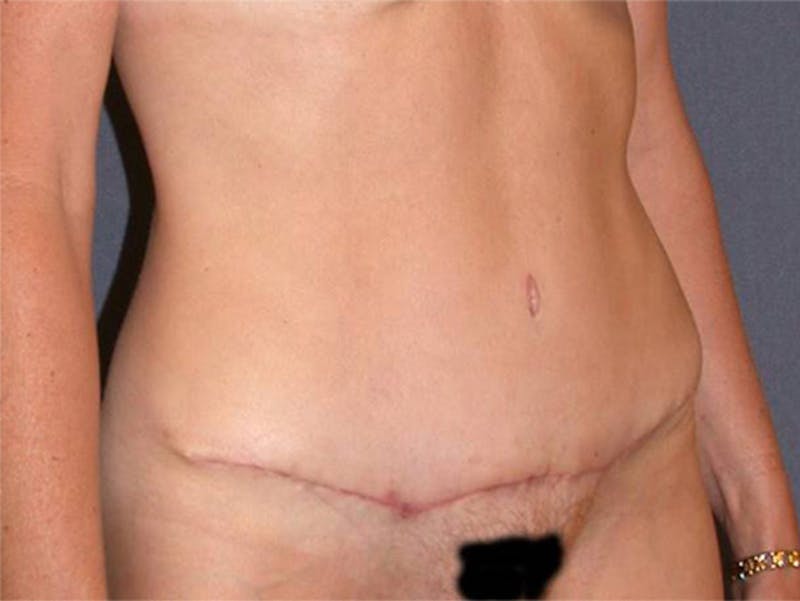 Tummy Tuck Before & After Gallery - Patient 167358357 - Image 4