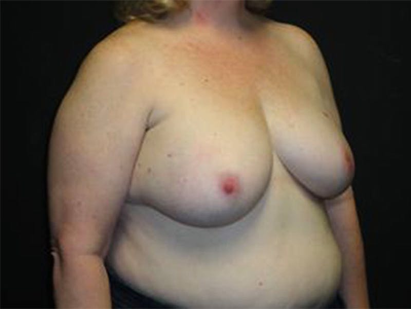 Breast Implant Reconstruction Before & After Gallery - Patient 167358358 - Image 3