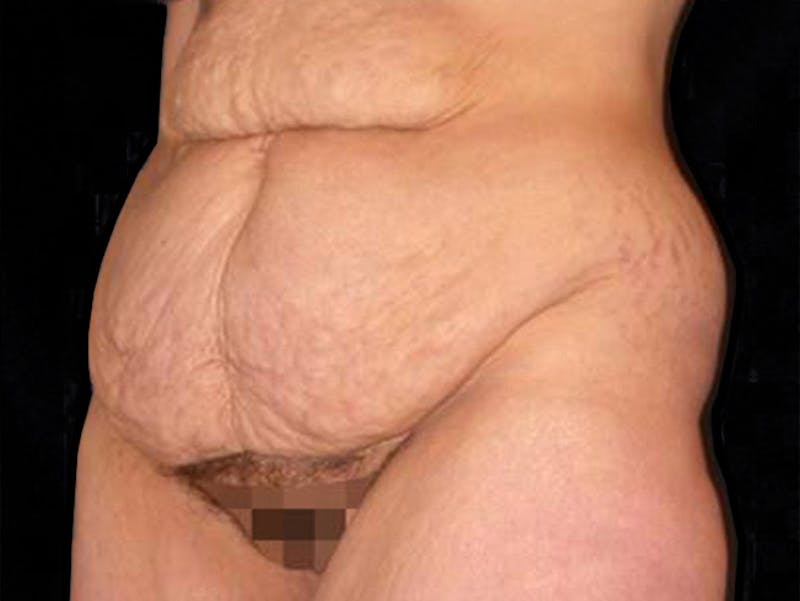 Liposuction Before & After Gallery - Patient 167358361 - Image 3
