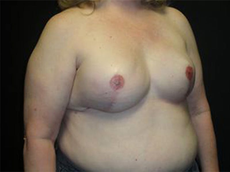 Breast Implant Reconstruction Before & After Gallery - Patient 167358358 - Image 4