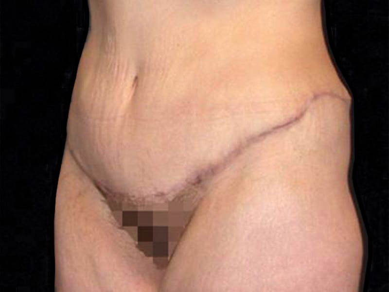 Liposuction Before & After Gallery - Patient 167358361 - Image 4