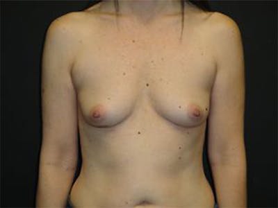 Breast Implant Reconstruction Before & After Gallery - Patient 167358364 - Image 1