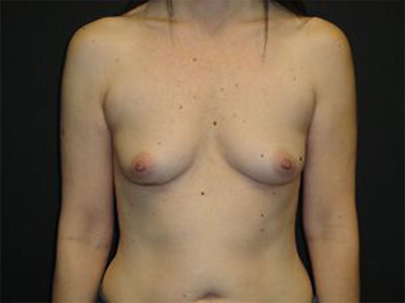 Breast Implant Reconstruction Before & After Gallery - Patient 167358364 - Image 1