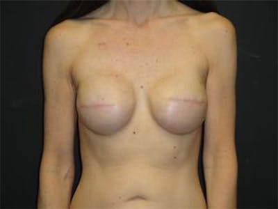 Breast Implant Reconstruction Before & After Gallery - Patient 167358364 - Image 2