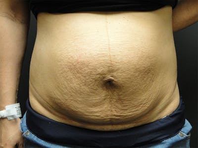 Tummy Tuck Before & After Gallery - Patient 167358366 - Image 1