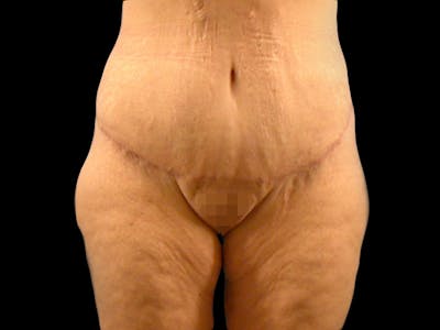 Body Lift Before & After Gallery - Patient 167358365 - Image 2