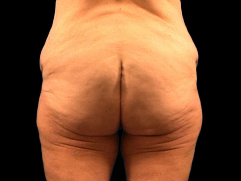 Body Lift Before & After Gallery - Patient 167358365 - Image 3