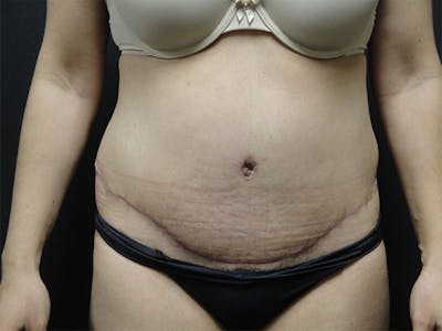 Tummy Tuck Before & After Gallery - Patient 167358366 - Image 2