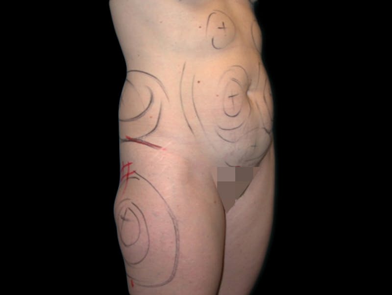 Liposuction Before & After Gallery - Patient 167358373 - Image 3