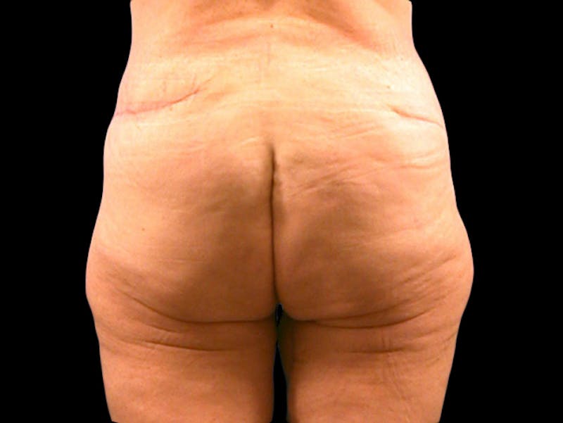 Body Lift Before & After Gallery - Patient 167358365 - Image 4