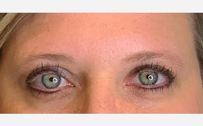 Microblading Before & After Gallery - Patient 167358372 - Image 1