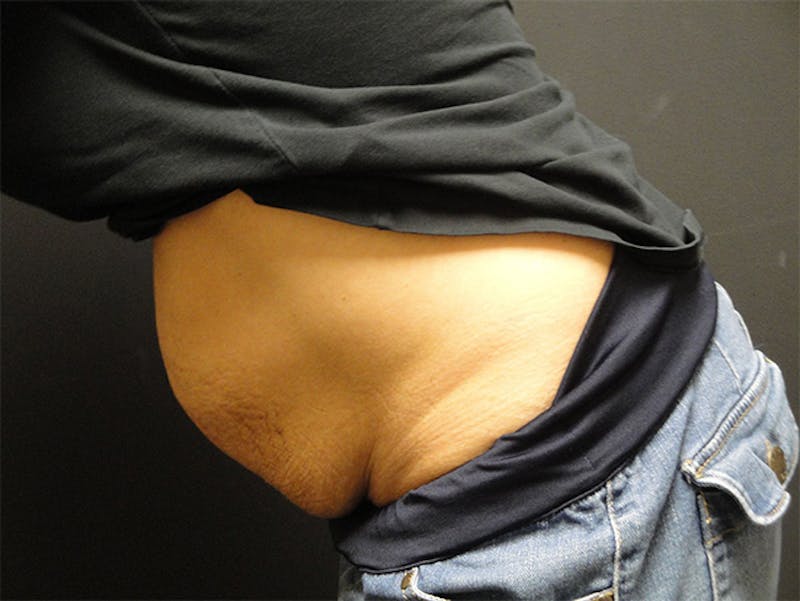 Tummy Tuck Before & After Gallery - Patient 167358366 - Image 3