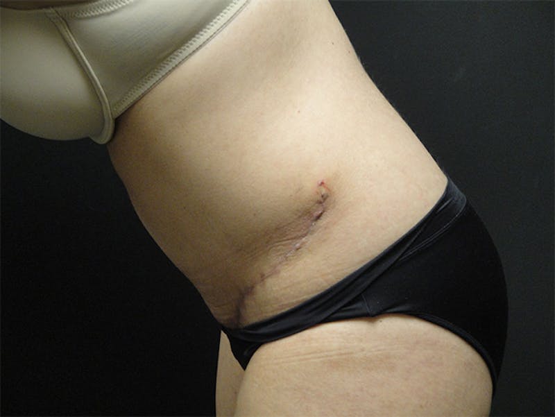 Tummy Tuck Before & After Gallery - Patient 167358366 - Image 4