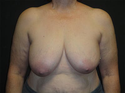 Breast Implant Reconstruction Before & After Gallery - Patient 167367509 - Image 1
